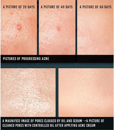 [Pyunkang yul] ACNE Cream 50ml